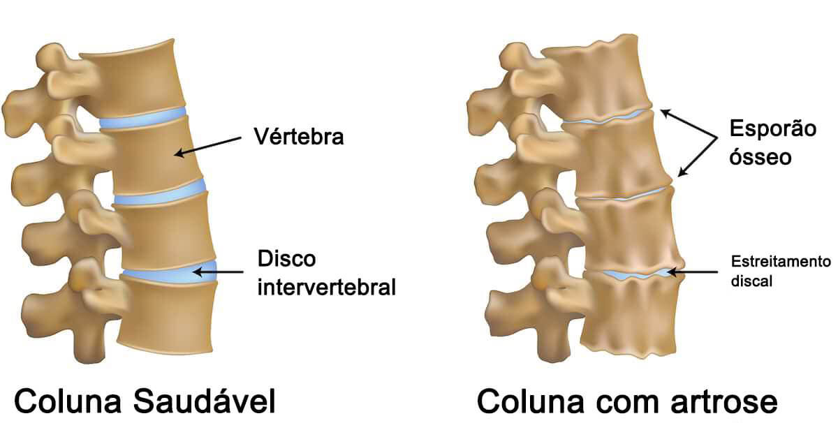 Artrose na coluna: o que é, causas, sintomas, diagnóstico e tratamento ...