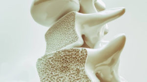 osteoporose na coluna