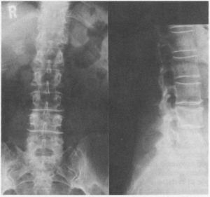 osteoporose na coluna