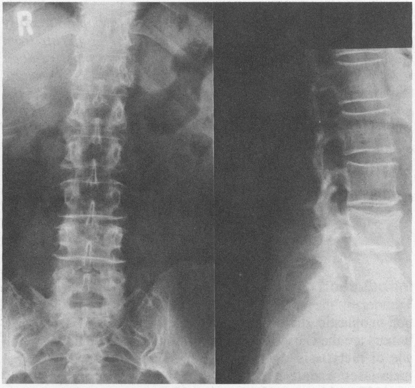 Osteoporose Na Coluna Causas Sintomas E Tratamento Dr Lohran Anguera